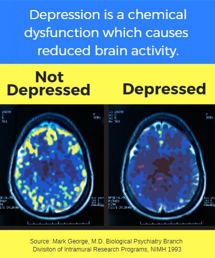 TMS Therapy Depression - Keystone Behavioral