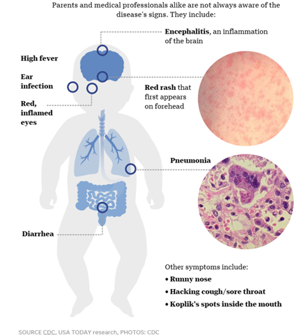 Parents and medical professionals alike are not always aware of the disease's signs. They include: Encephalitis, an inflammation of the brain. High fever, ear infection, red, inflamed eyes, diarrhea, red rash that first appears on forehead, pneumonia. Other symptoms include runny nose, hacking cough, sore throat, Koplik's spots inside the mouth.