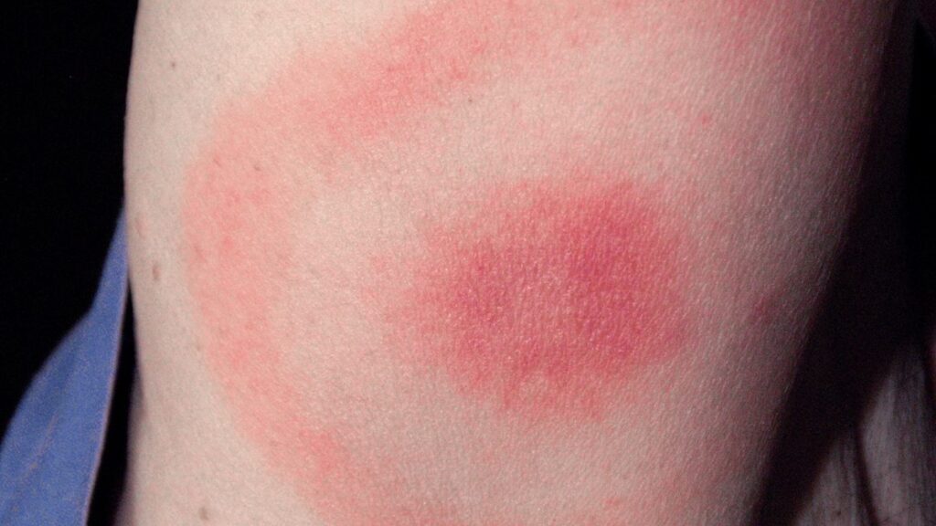 A red rash with a solid circle in the middle, surrounded by a red circular outline 